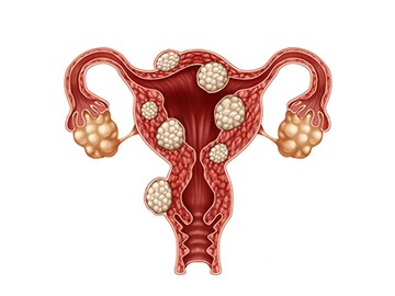 Los miomas, tumores benignos, comunes y asintomáticos